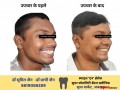 dentist-in-jabalpur-dr-sumit-jain-dental-clinic-jabalpur-smile-n-braces-dental-clinic-in-jabalpur-laser-and-orthodonitic-centre-in-jabalpur-small-5