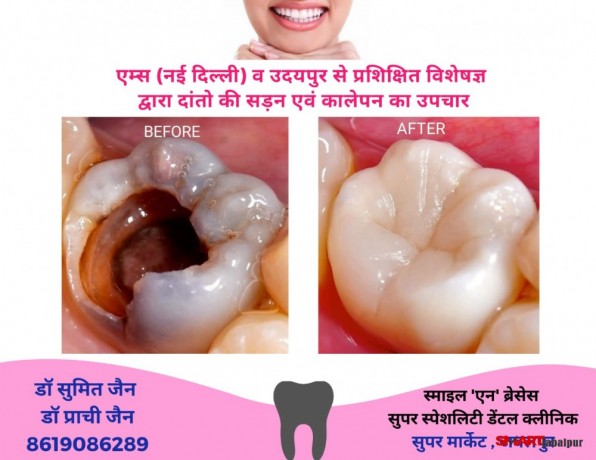 dentist-in-jabalpur-dr-sumit-jain-dental-clinic-jabalpur-smile-n-braces-dental-clinic-in-jabalpur-laser-and-orthodonitic-centre-in-jabalpur-big-1