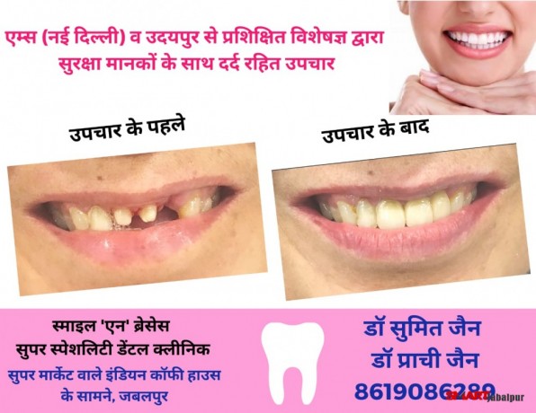 dentist-in-jabalpur-dr-sumit-jain-dental-clinic-jabalpur-smile-n-braces-dental-clinic-in-jabalpur-laser-and-orthodonitic-centre-in-jabalpur-big-2