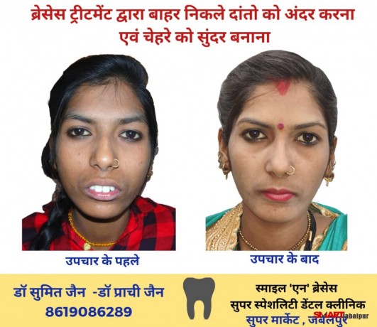dentist-in-jabalpur-dr-sumit-jain-dental-clinic-jabalpur-smile-n-braces-dental-clinic-in-jabalpur-laser-and-orthodonitic-centre-in-jabalpur-big-4