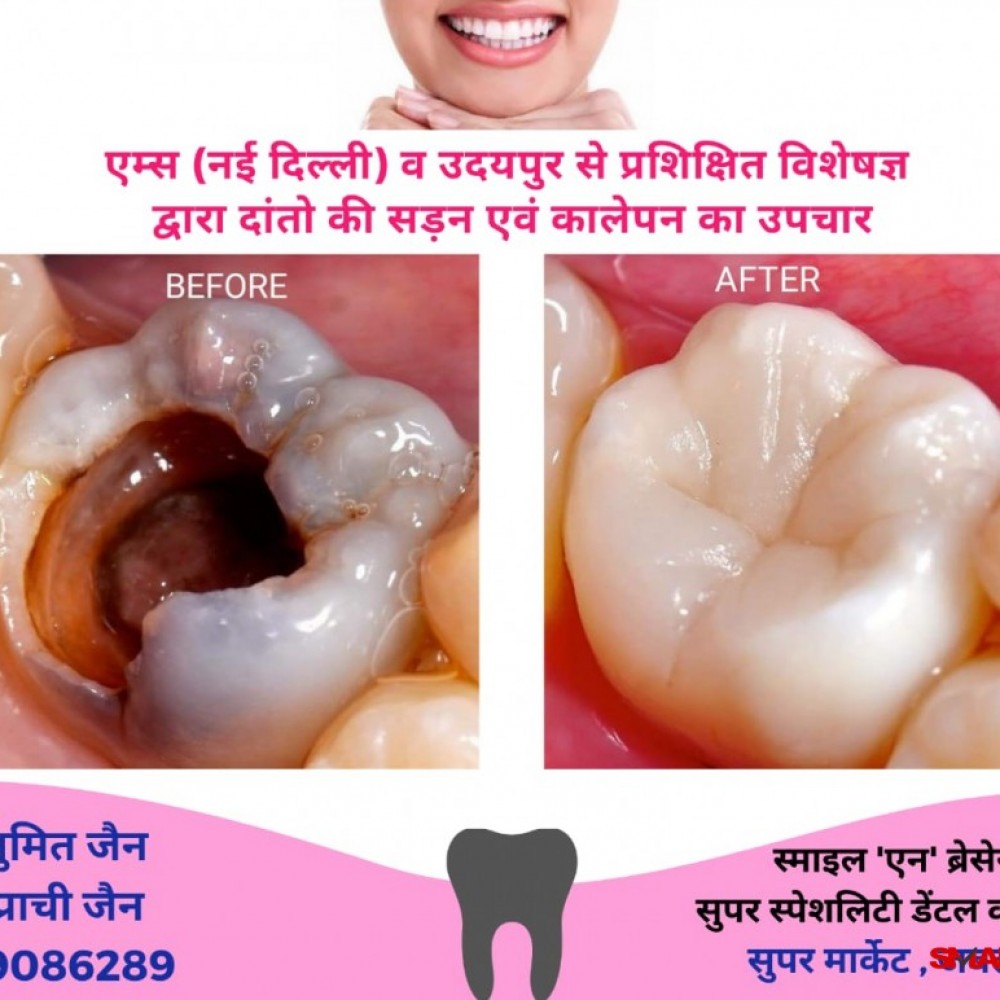 Read This To Change How You cost of composite fillings