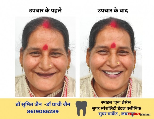 best-dentist-and-dental-surgeon-orthodontist-clinic-in-jabalpur-dr-sumit-jain-smile-n-braces-superspeciality-dental-clinic-best-dental-clinic-big-5