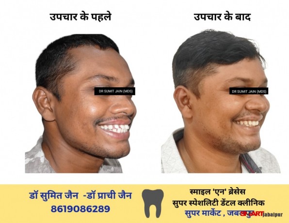 best-dentist-and-dental-surgeon-orthodontist-clinic-in-jabalpur-dr-sumit-jain-smile-n-braces-superspeciality-dental-clinic-best-dental-clinic-big-7